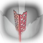 Narożnik aluminiowy 2.5 perforowany zwykły
